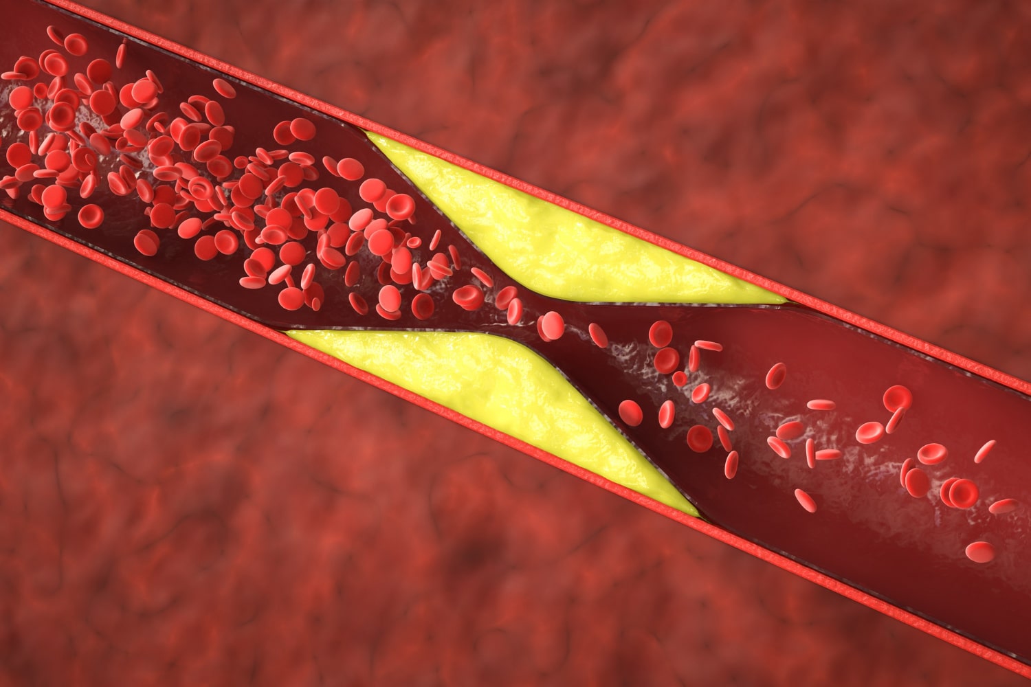 Zvýšená kyselina močová a cholesterol: Skrytá súvislosť