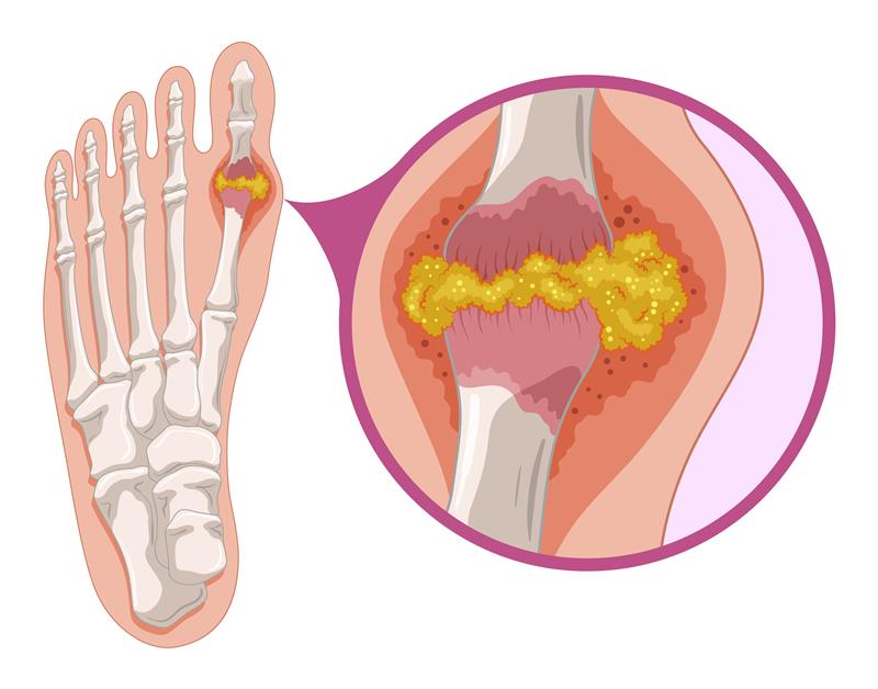 Hyperurikémia: Tichý spúšťač vážnych ochorení